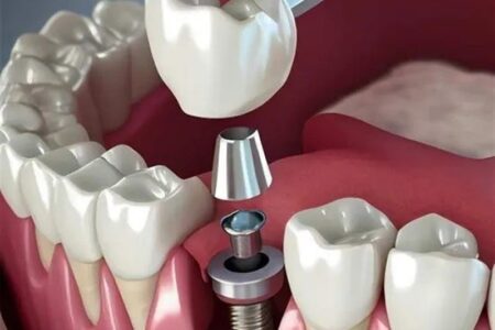 تبلیغ ایمپلنت فوری دروغ است/سلبریتی‌ها حق تبلیغ خدمات پزشکی را ندارند