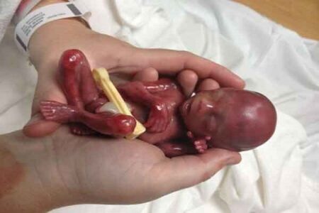 سقط جنین؛ از «صنعت پول‌های سیاه» تا عوارض جبران‌ناپذیر جسمی و روانی