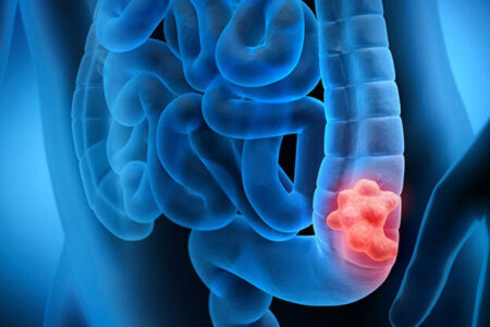 مصرف مشروبات الکلی خطر ابتلا به سرطان روده بزرگ را افزایش می‌دهد